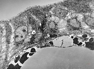 Whipple disease Whipple disease
